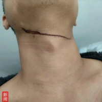 男子夜骑遭晾衣绳“割喉”